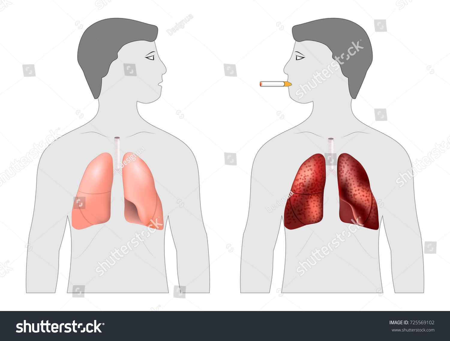 Smoker's and healthy lungs. before and after a - Royalty Free Stock ...