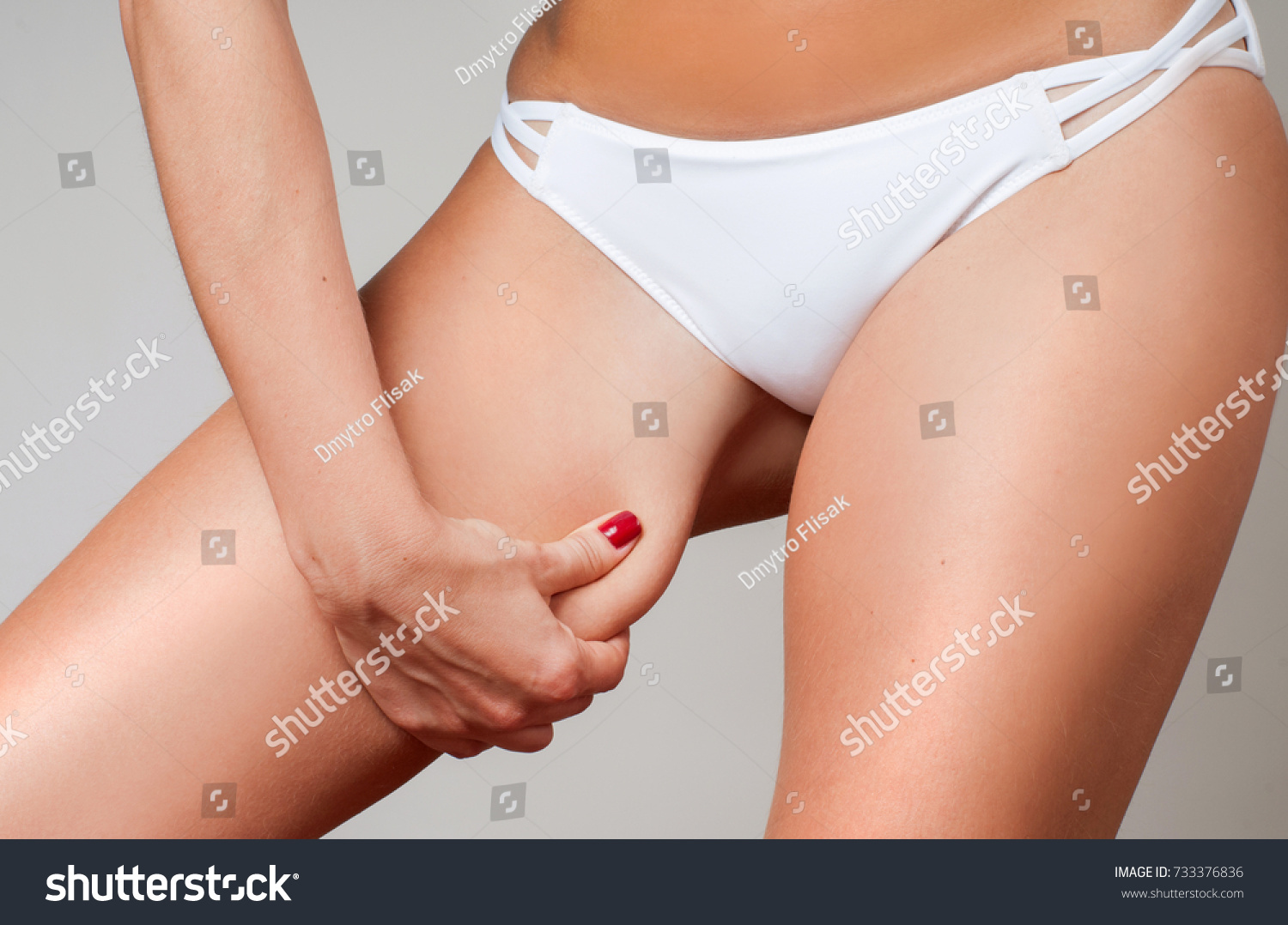  Woman grabbing skin on her leg. Cellulite fat removal skin. Lose weight and liposuction cellulite removal concept #733376836