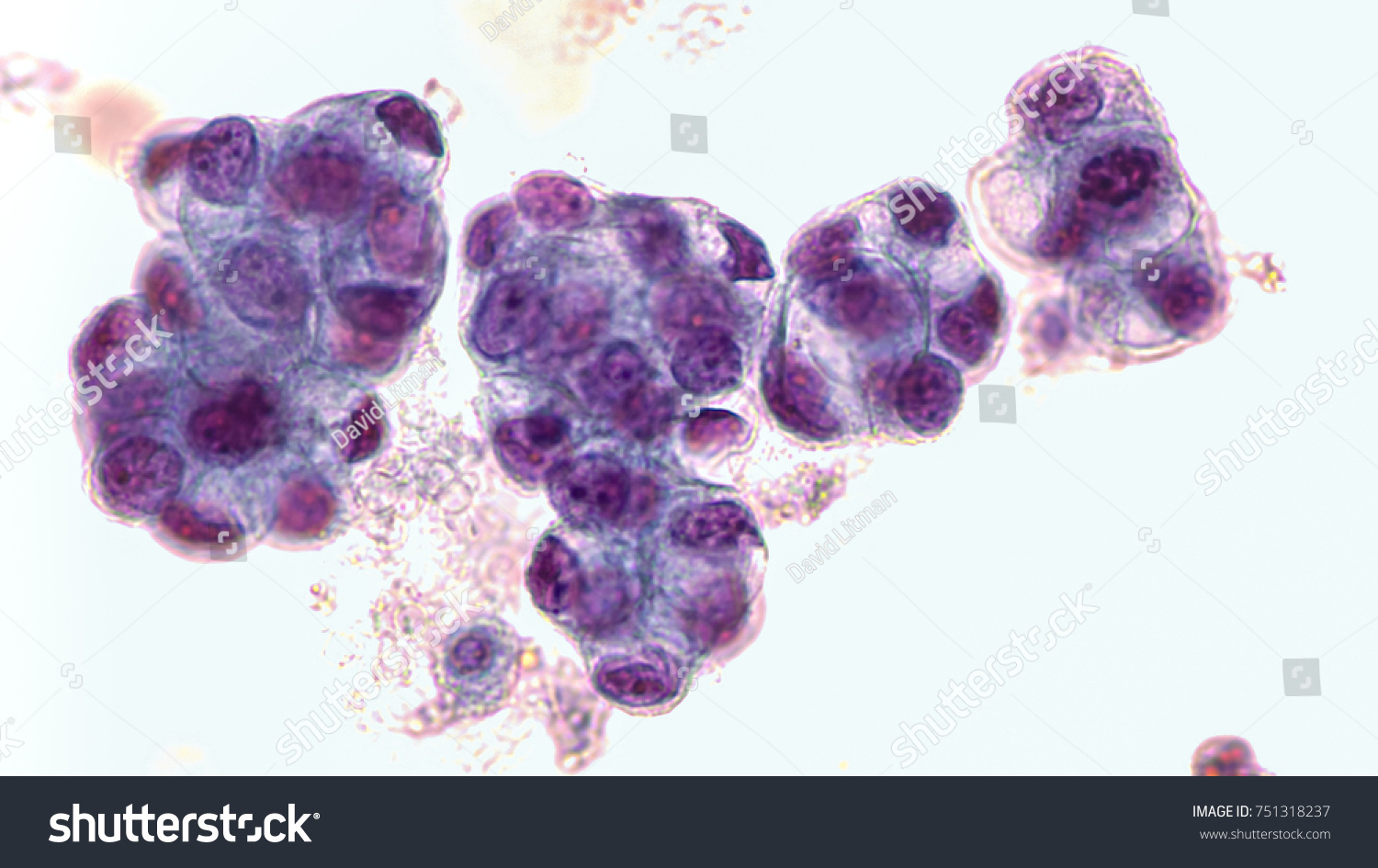 Malignant fluid cytology;   Malignant cells of adenocarcinoma may spread to fluid of  pleural or peritoneal cavity in cancer from the breast,  lung, colon, pancreas, ovary, endometrium or other sites. #751318237