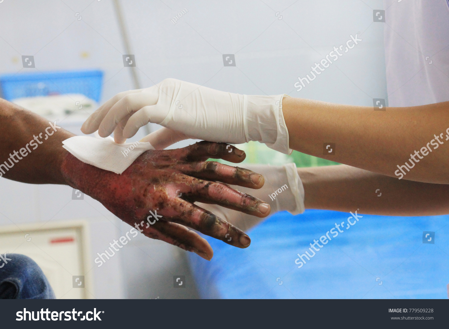 Dressing wound burn of second degree of wrist and hand with blur #779509228