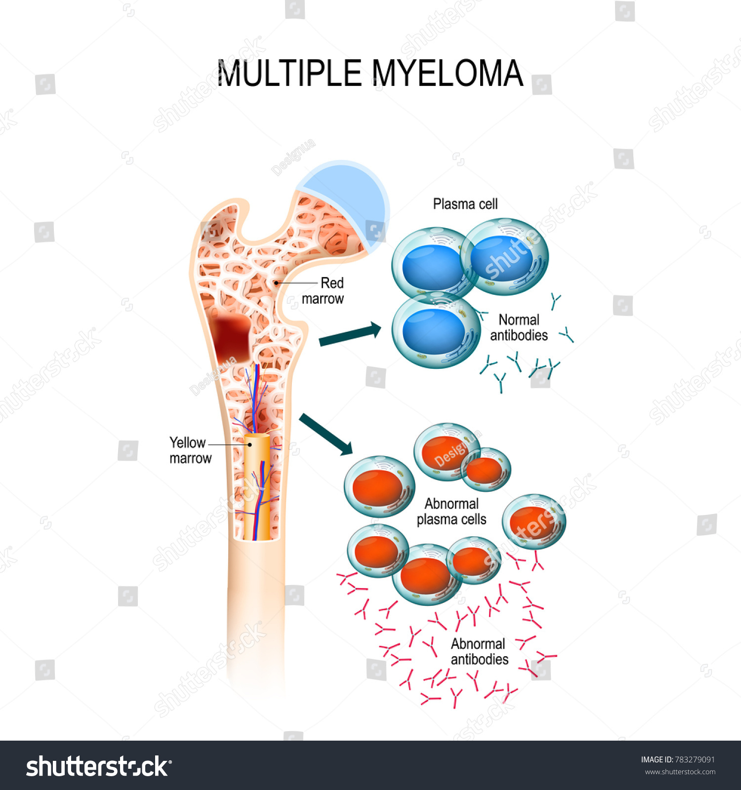 Myeloma cells suppress the growth of healthy - Royalty Free Stock Photo ...