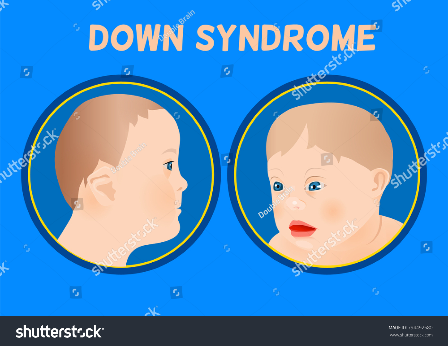 Symptoms Of Down Syndrome Poster Abnormal Ears Royalty Free Stock Vector 794492680 5170