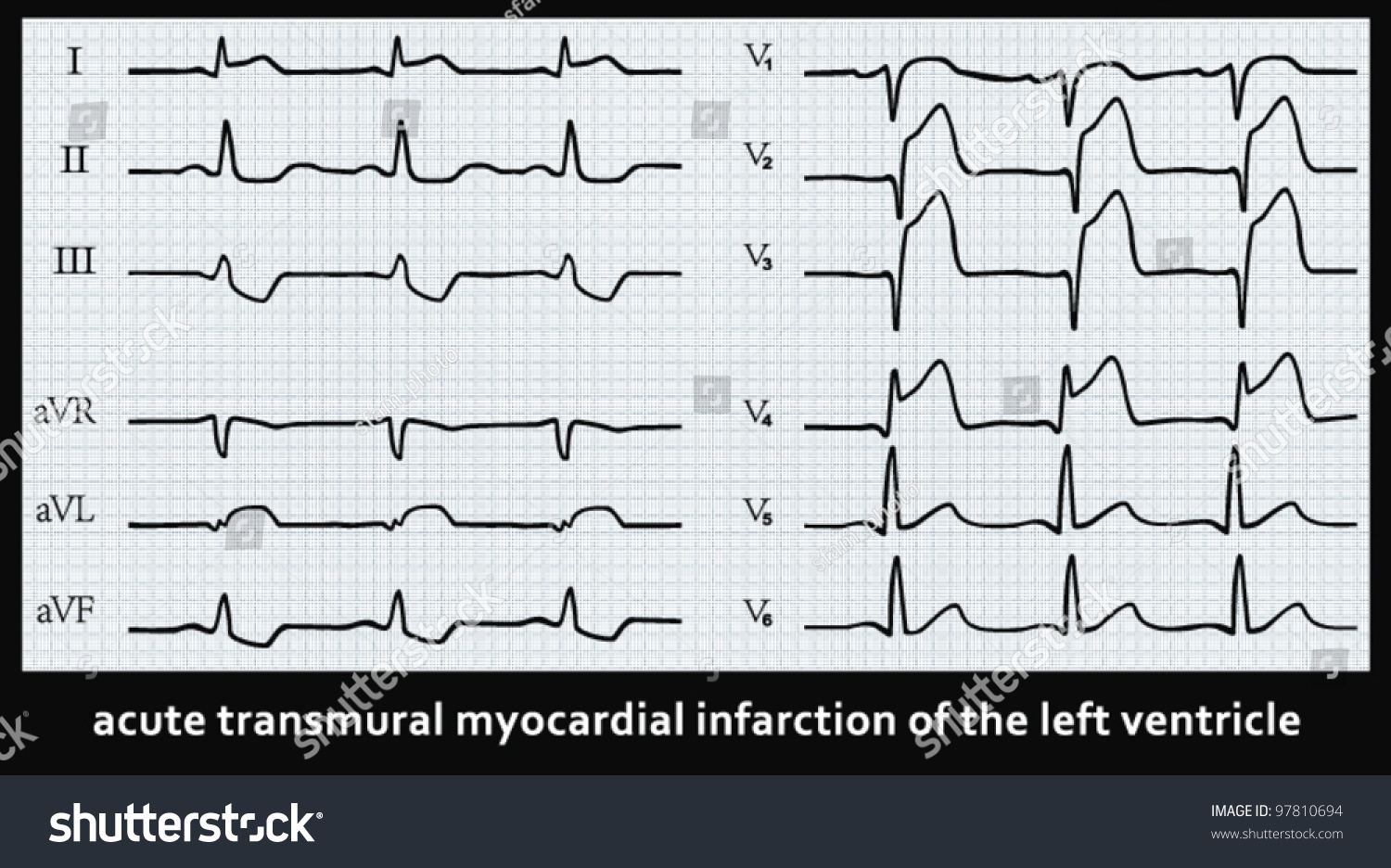 myocardial infarction on ECG - Royalty Free Stock Vector 97810694 ...