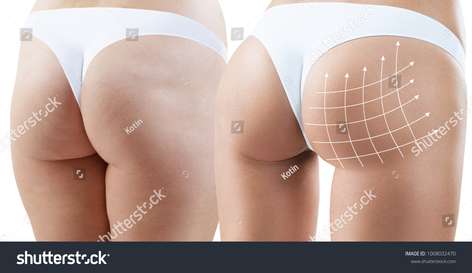 Female buttocks with arrows grid before and after plastic surgery. #1008032470