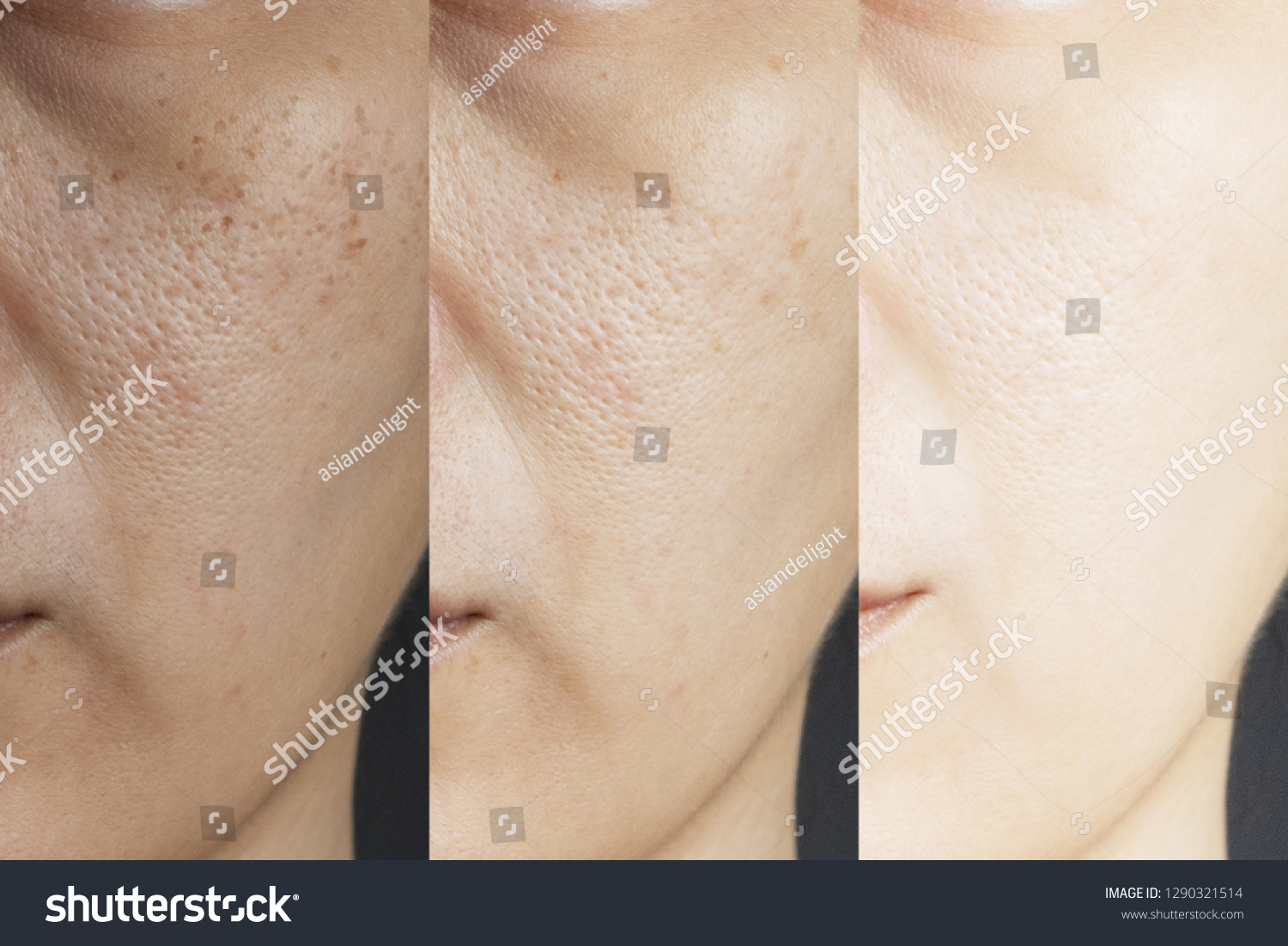 three pictures compared effect Before and After treatment. skin with problems of freckles , pore , dull skin and wrinkles before and after treatment to solve skin problem for better skin result #1290321514