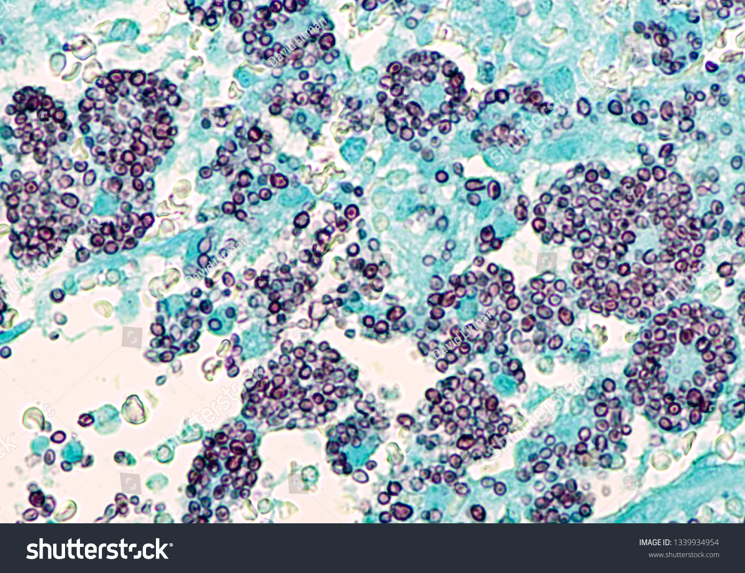 Microscopic of disseminated histoplasmosis, a type of fungal infection  by the fungus Histoplasma capsulatum.  Yeast forms appear as black  spherules within the cytoplasm of macrophages. GMS stain.  #1339934954
