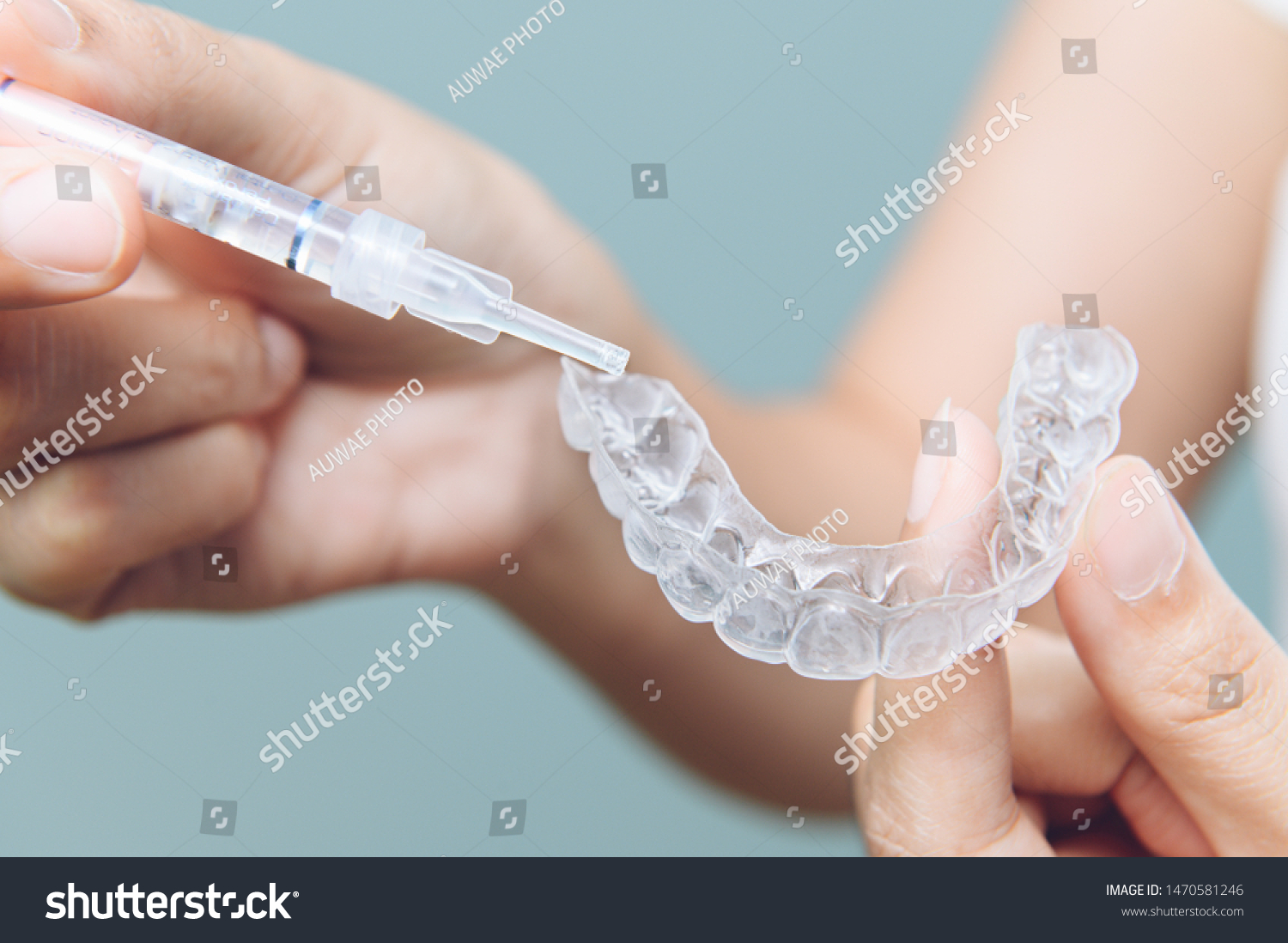 Tooth whitening gel being applied to a tooth mold in preparation for being placed in the mouth. #1470581246