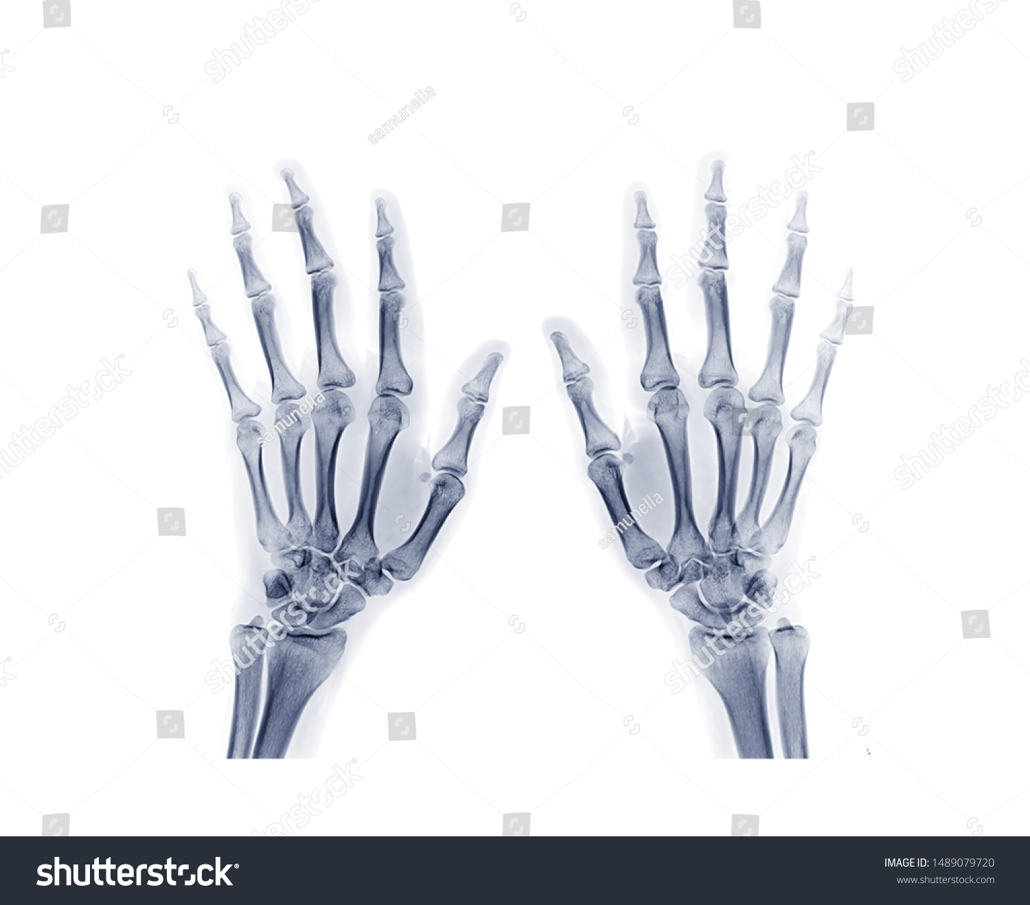  both hand AP view isolated on white background . x-ray image of hand. #1489079720