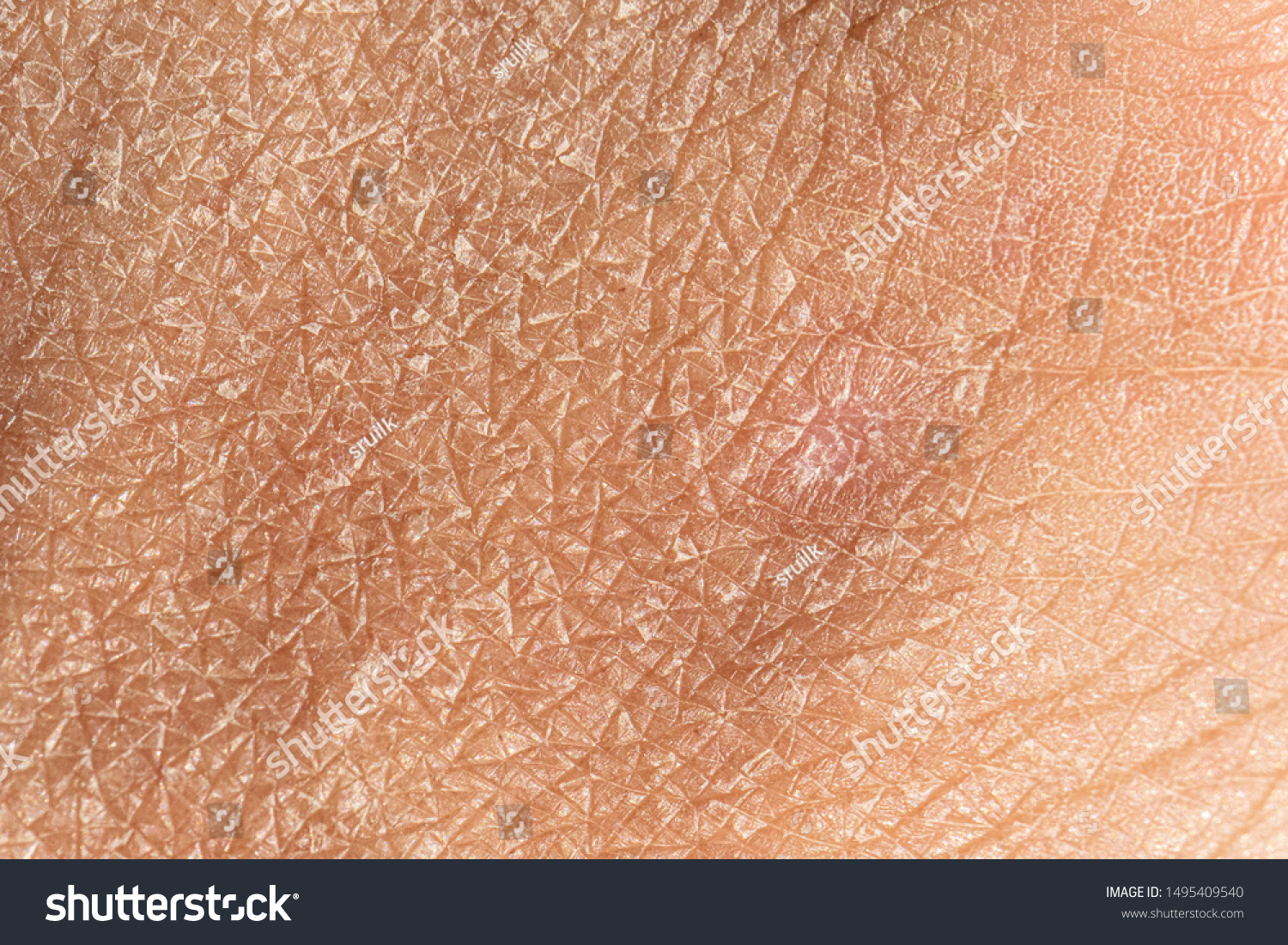 Dermatology and skincare concept with a macro view on the flaking skin of a caucasian person. Detailed view of the cracks and lines filling the frame. #1495409540