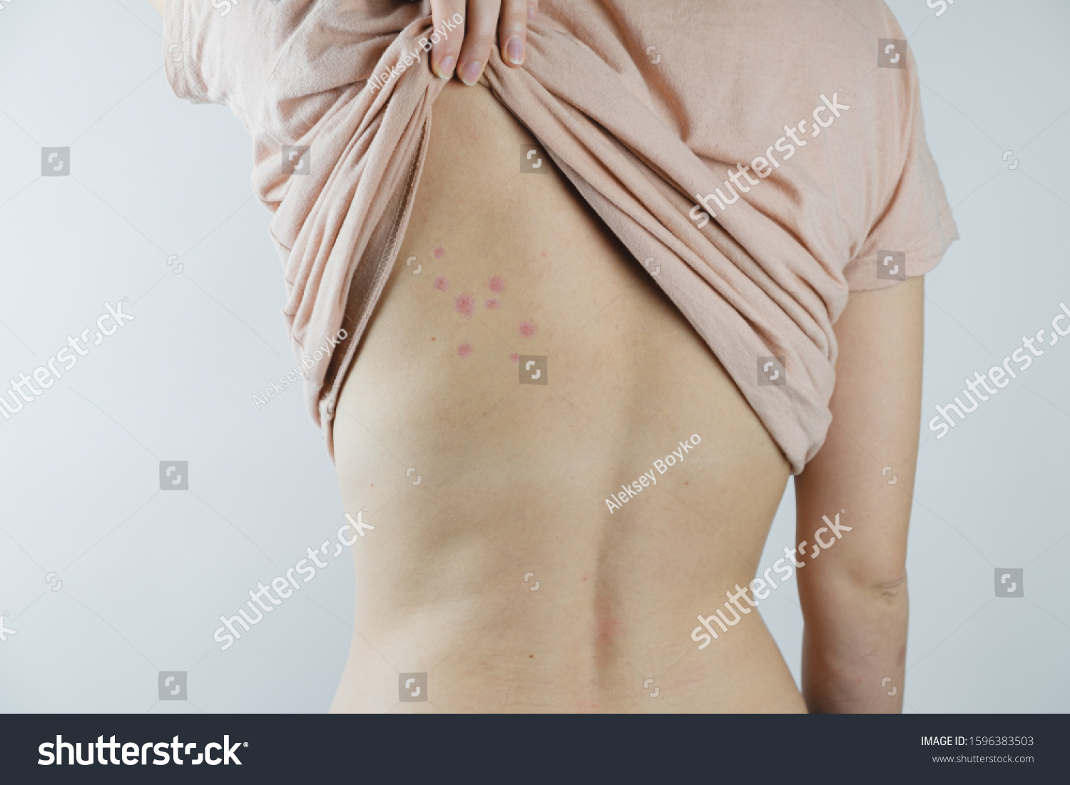 Damaged skin on female's back. Bedbug bites, moosquito bites or skin disease on human body #1596383503