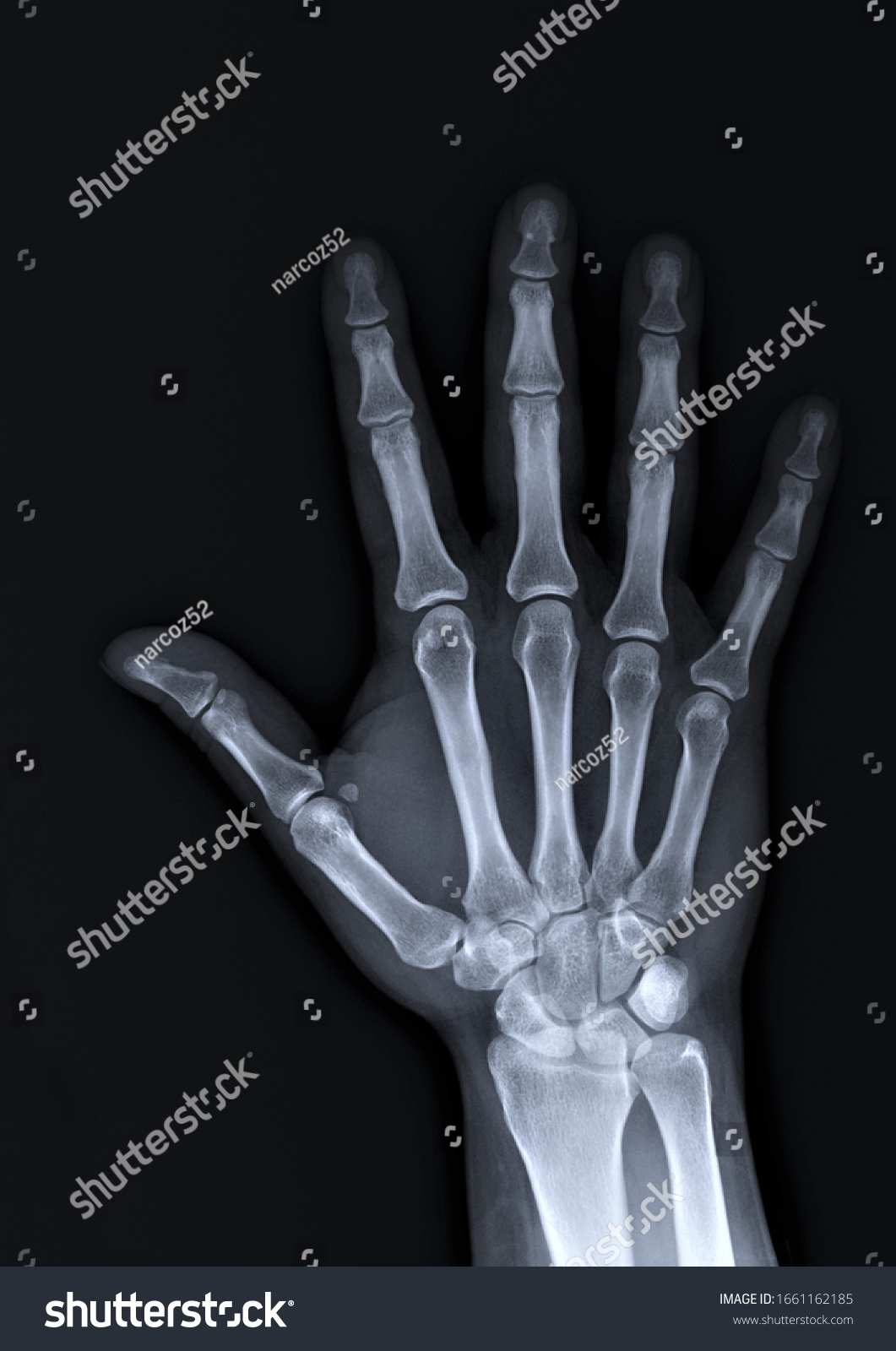 x-ray of the hand and wrist bones #1661162185