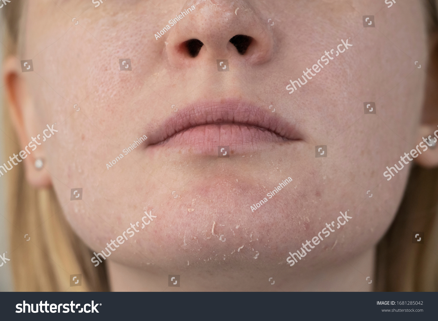 A woman examines dry skin on her face. Peeling, coarsening, discomfort, skin sensitivity. Patient at the appointment of a dermatologist or cosmetologist, selection of cream for dryness #1681285042