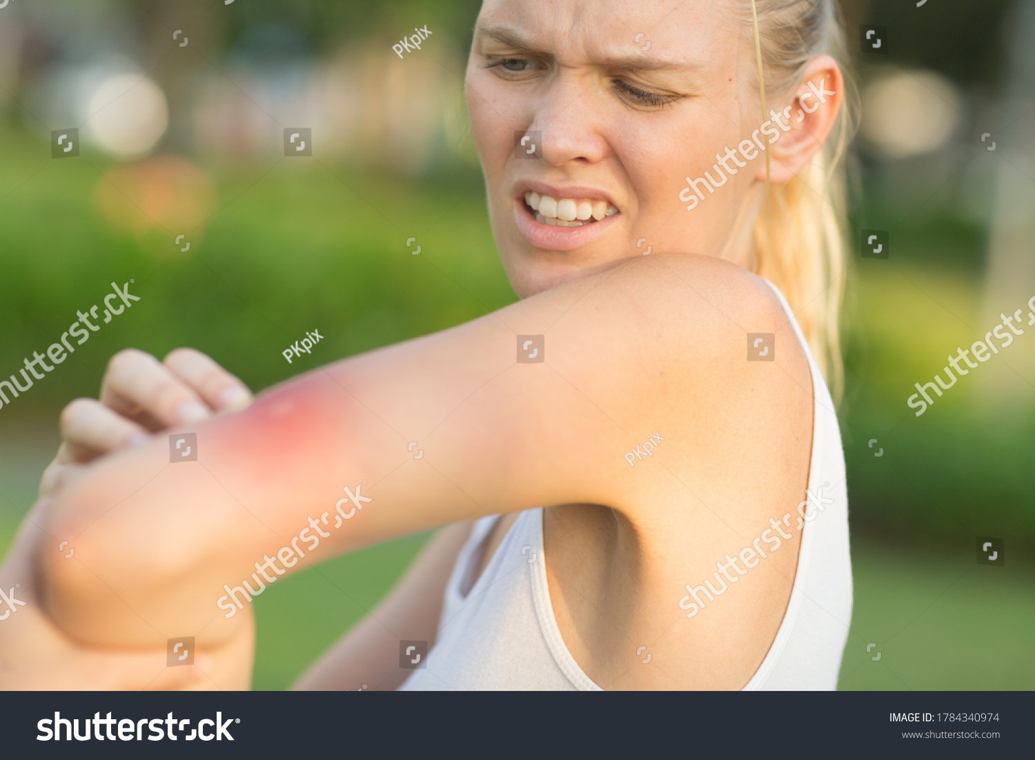 Itchy insect bite - Irritated young female scratching her itching arm from a mosquito bite at the park during summertime. #1784340974