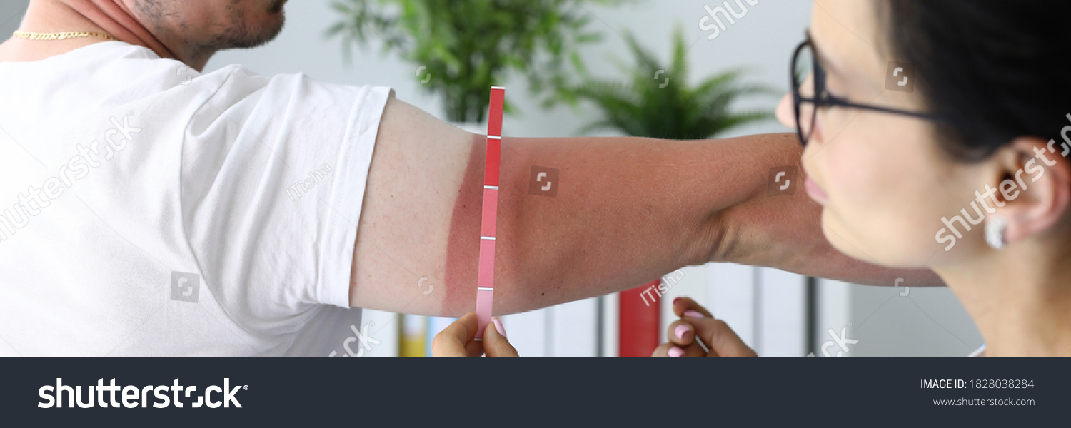 Healthcare professional determines the extent of patient's burn. Sunburn on skin concept #1828038284