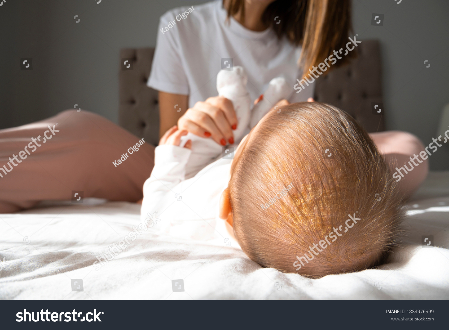 A baby girl has infantile Seborrheic Dermatitis - cradle cap and lying in bed with her mother. white backgrund and isolated. newborn baby. selective focus. #1884976999