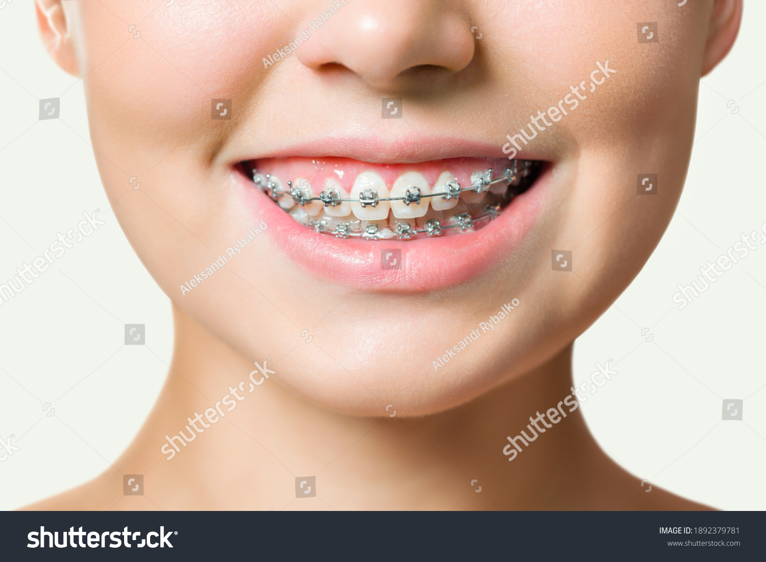 Orthodontic Treatment. Dental Care Concept. Beautiful Woman Healthy Smile close up. Closeup Ceramic and Metal Brackets on Teeth. Beautiful Female Smile with Braces #1892379781