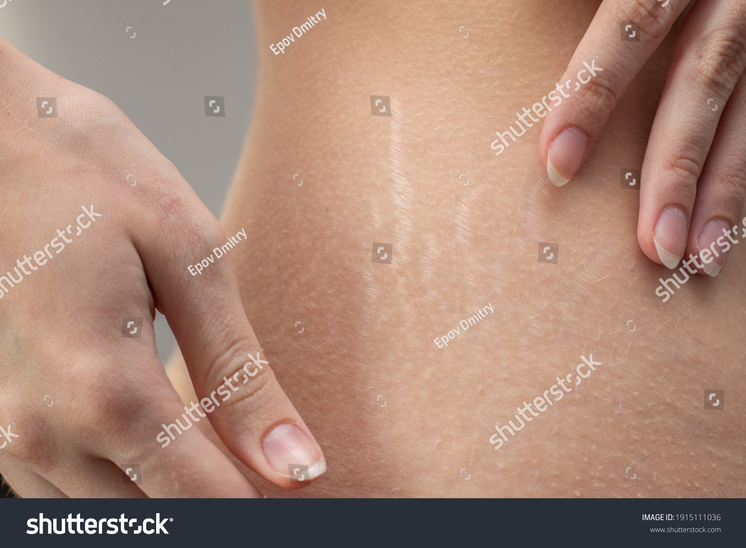 Woman hips with visible stretch marks. Young woman showing Stretch mark scars on her body. #1915111036