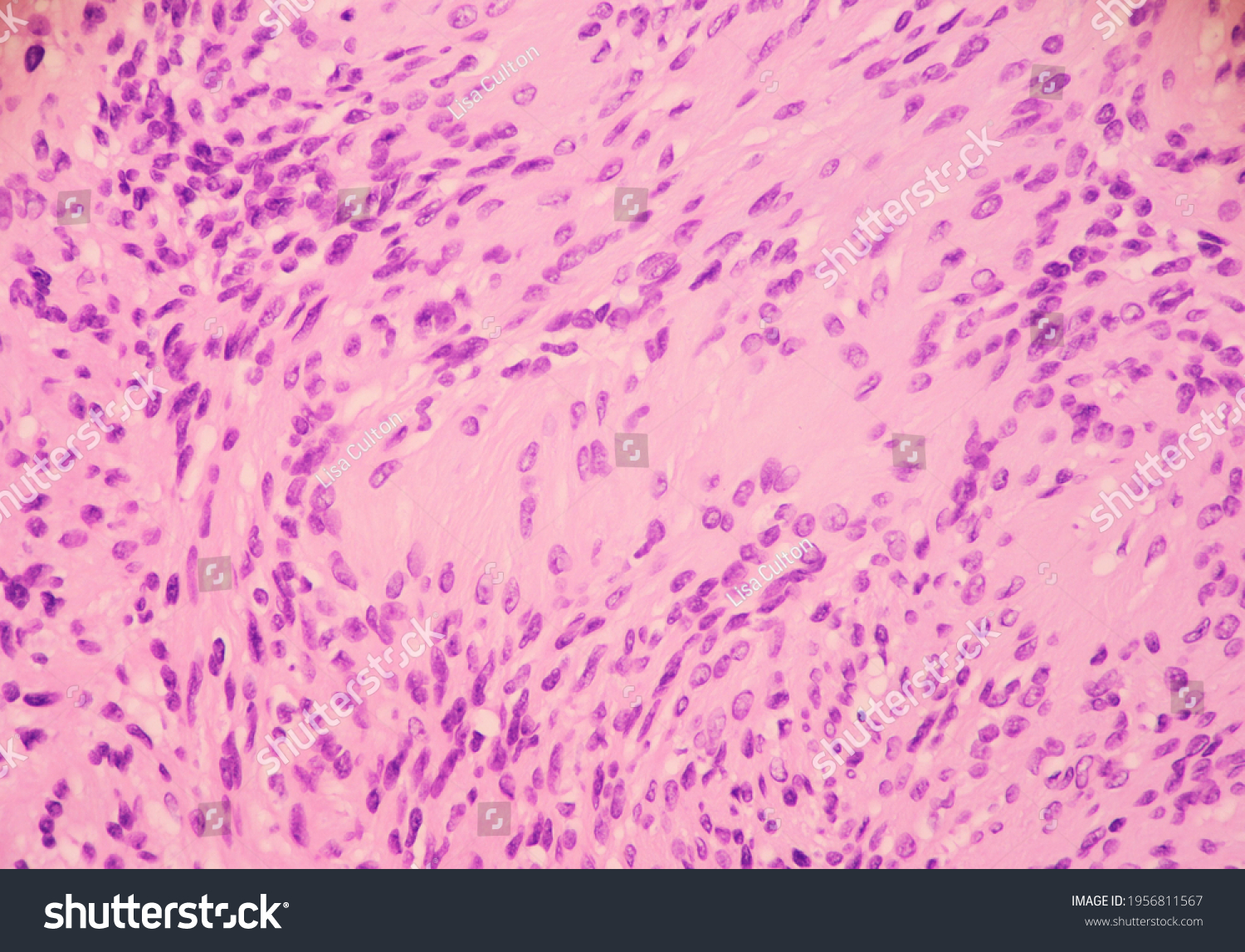 Benign nerve sheath tumor called a Schwannoma. Microscopic view. #1956811567