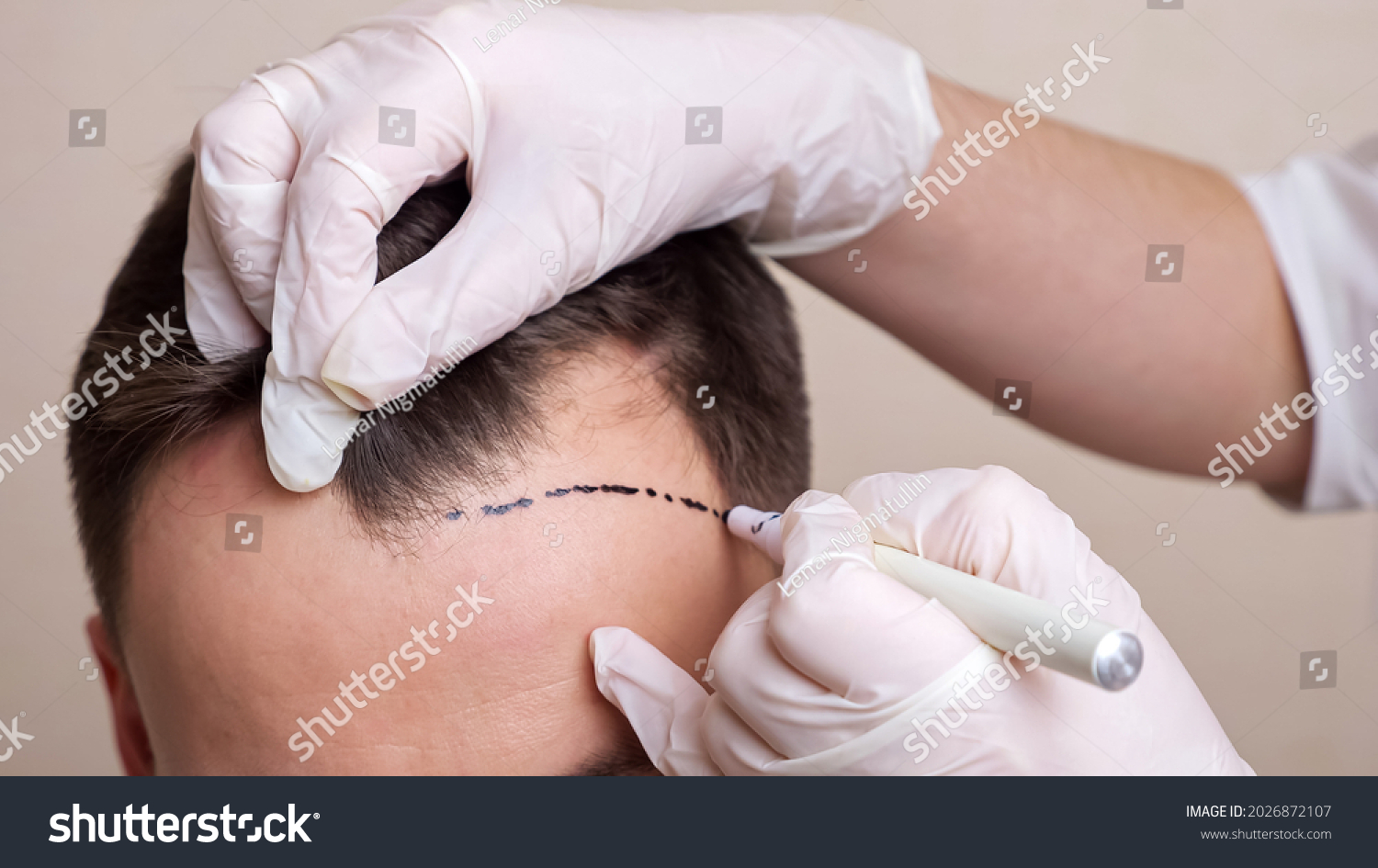 medical professional with gloves draws a dotted line on the head of a balding man. #2026872107