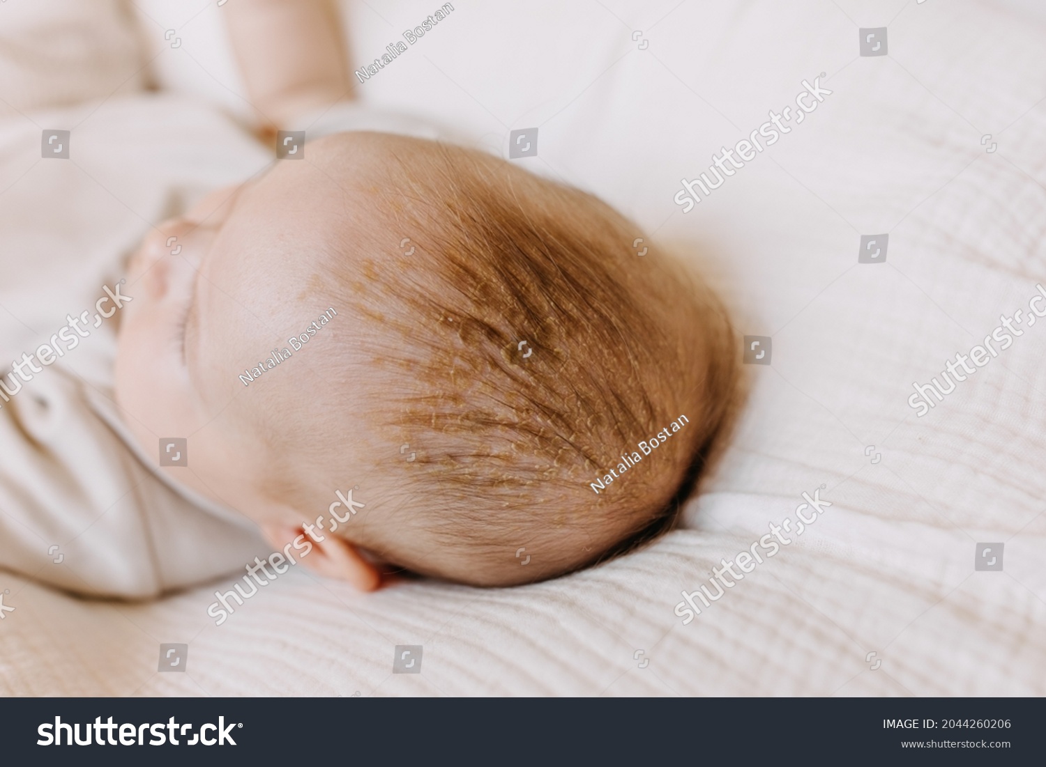 Closeup of baby head with cradle cap. Dry skin on baby scalp. #2044260206