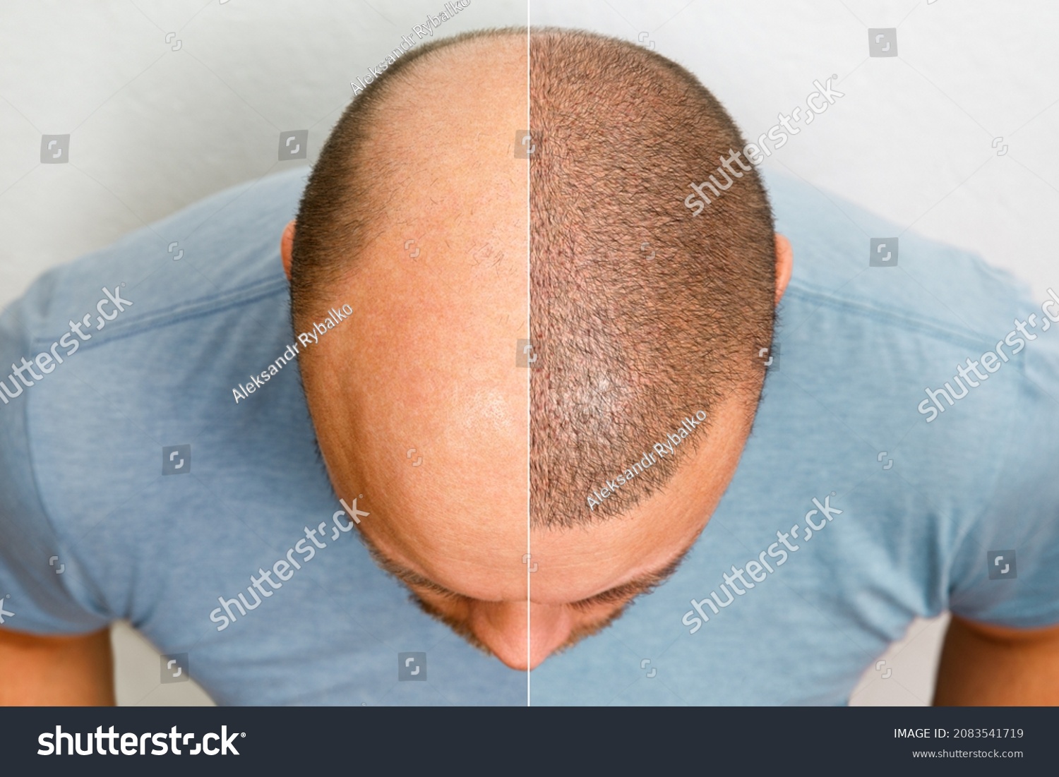 The head of a balding man before and after hair transplant surgery. A man losing his hair has become shaggy. An advertising poster for a hair transplant clinic. Treatment of baldness. #2083541719