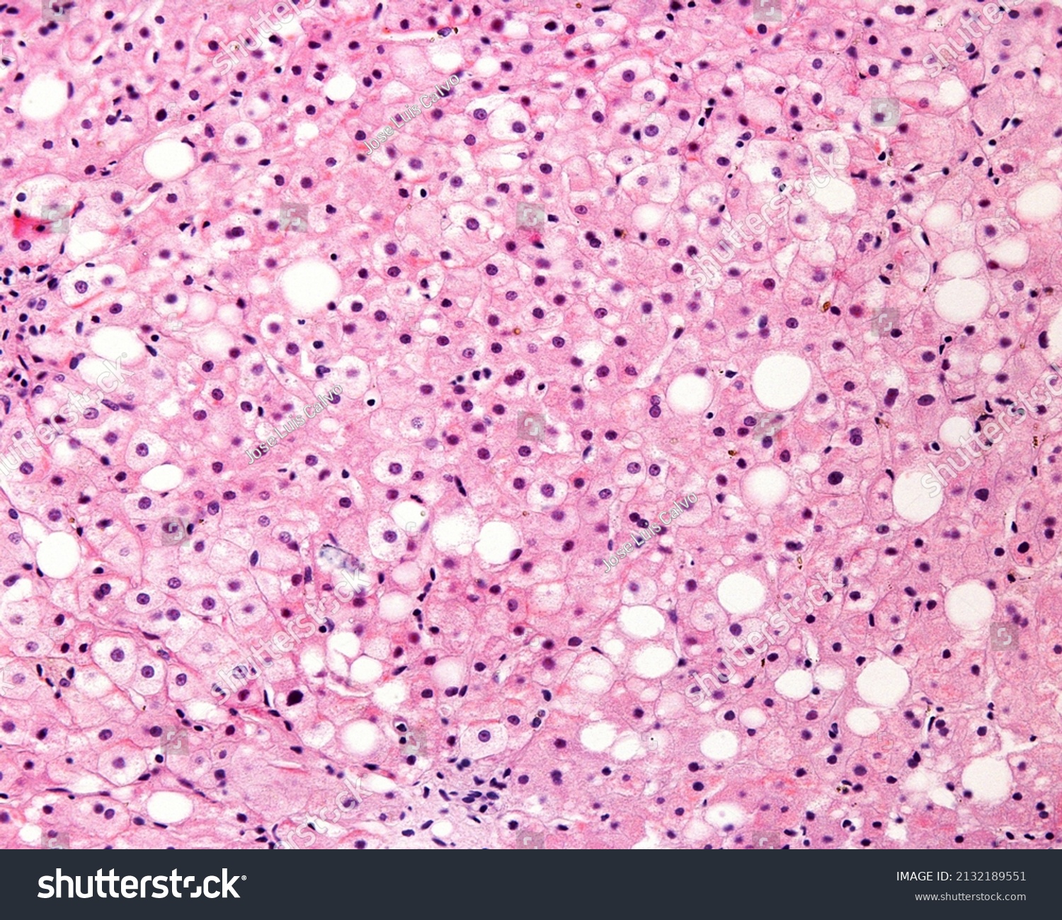Human liver affected by macrovesicular steatosis (fatty degeneration). Many hepatocytes show a big single fat droplet that pushes the nucleus and cytoplasm to the periphery of the cell. #2132189551