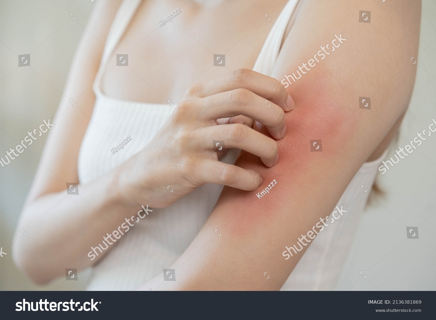 Dermatology, asian young woman, girl allergy, allergic reaction from atopic, insect bites on her arm, hand in scratching itchy, itch red spot or rash of skin. Healthcare, treatment of beauty. #2136381869