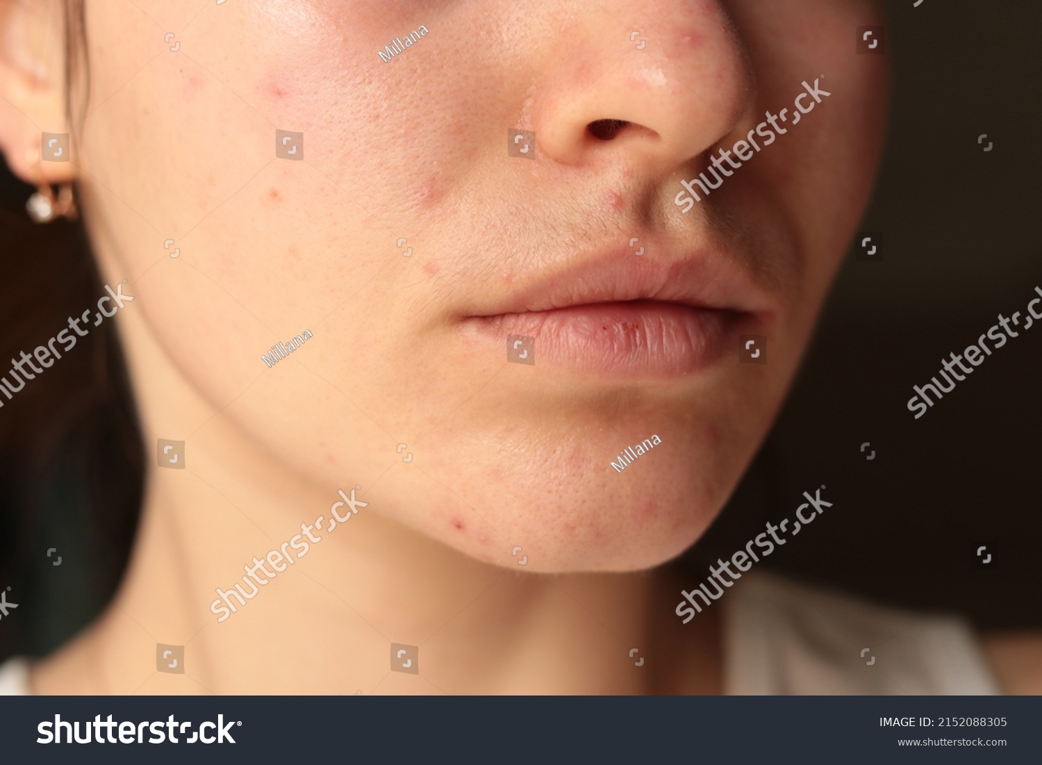 acne problem on chin. pimples on the face of a young girl. mustache in women

 #2152088305
