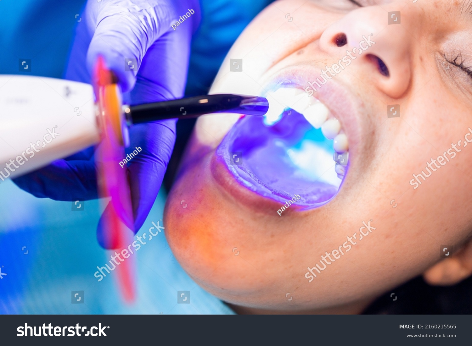 Tooth restoration with filling and polymerization lamp. Dental curing light setting composite resins. #2160215565