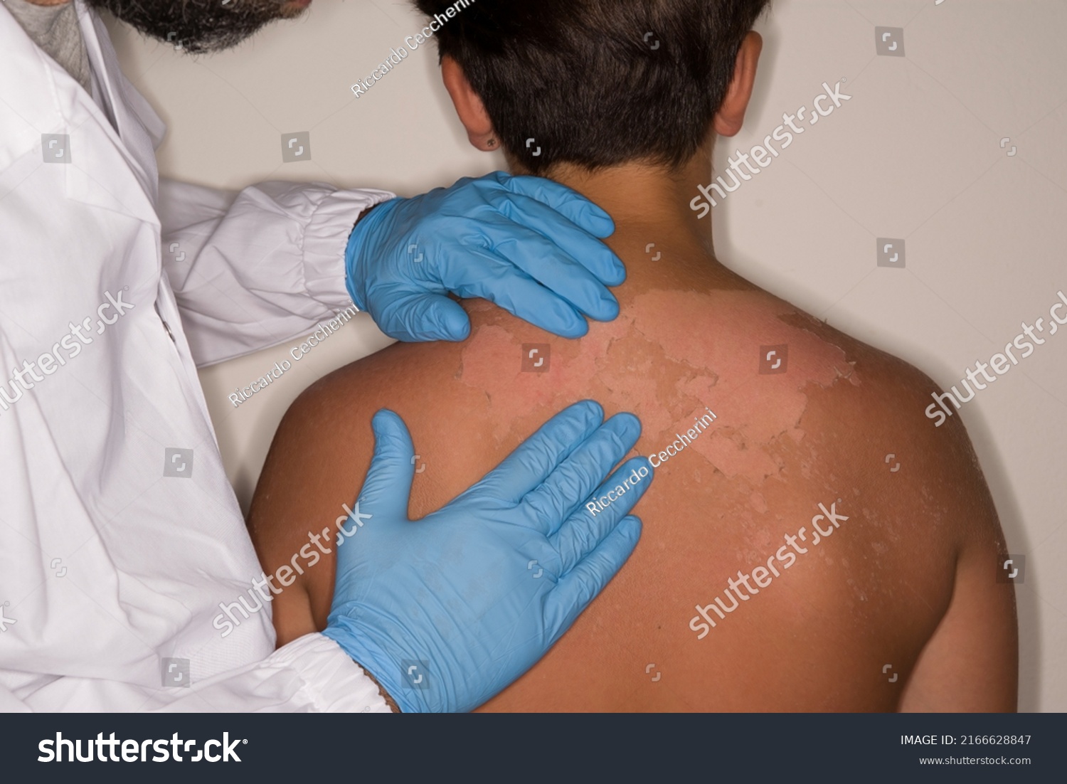 A doctor is evaluating the extent of the skin abrasion on the back of an 11-year-old child from a medium-intensity sunburn. #2166628847