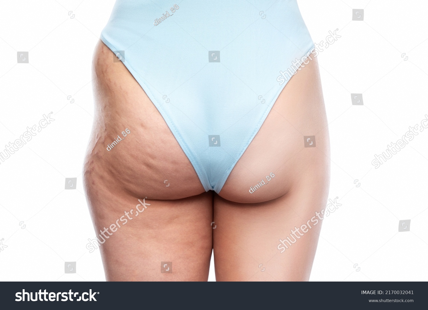 Buttocks and legs of a fat woman with cellulite and stretch marks before and after losing weight. Overweight treatment. #2170032041