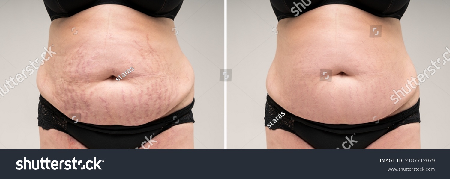 Before and after removing stretch marks from the skin, fat flabby female belly on gray background, skin care concept #2187712079