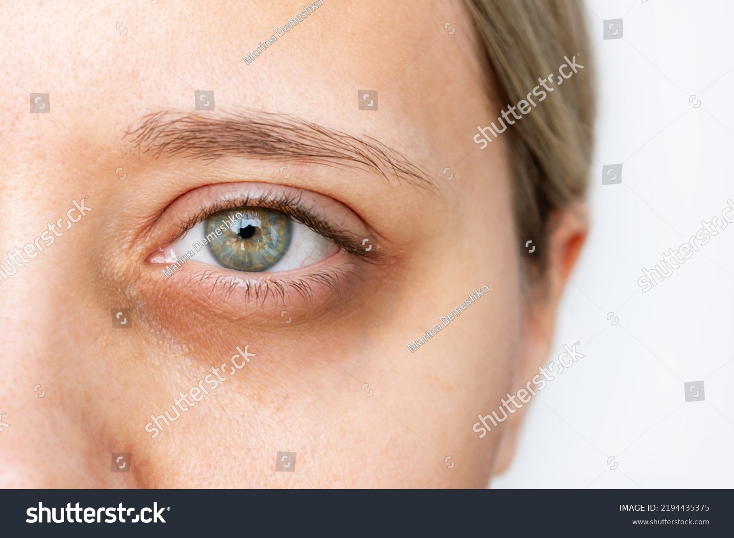 Cropped shot of a young caucasian woman's face with dark circle under eye isolated on a white background. Pale skin, bruises under eyes. Insomnia, stress #2194435375