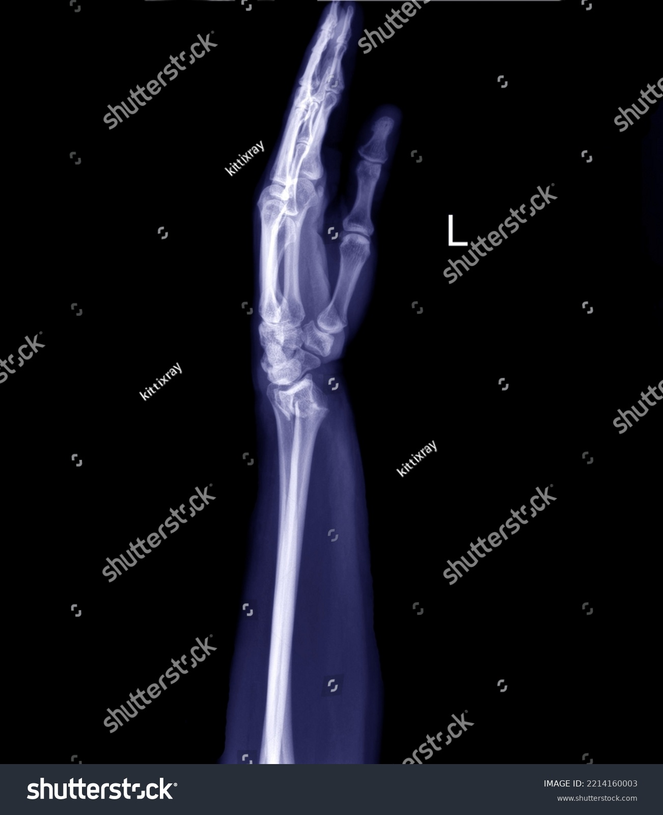 Radiograph of left wrist fracture of distal radius in posterair -anterior position. #2214160003