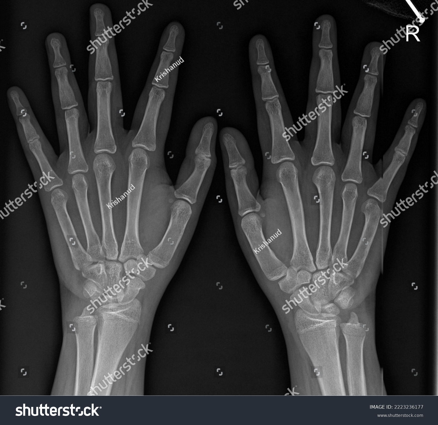 Left and Right Hand Posteroanterior Radiograph  #2223236177