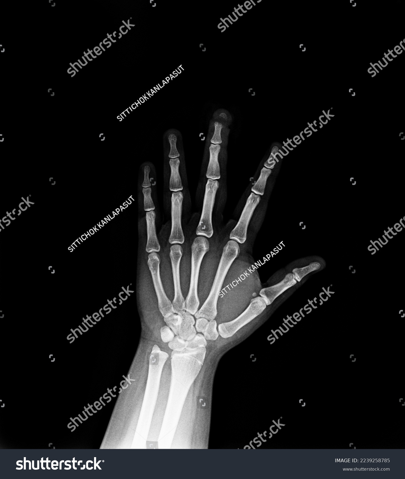 film x-ray  finger of fracture  #2239258785