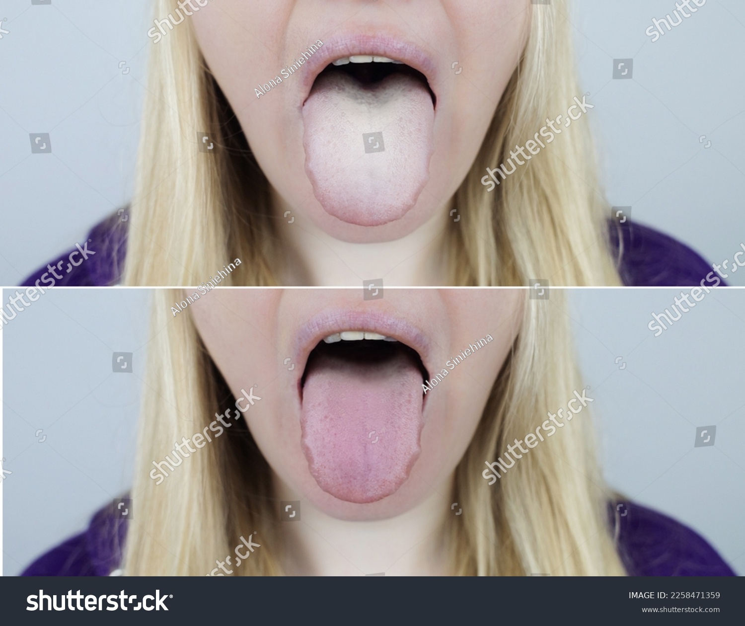 Woman has a white tongue. Painful white coating on the mucous membrane of the tongue. Diseases of the gastrointestinal tract, liver and gallbladder. The consequences of taking antibiotics. #2258471359