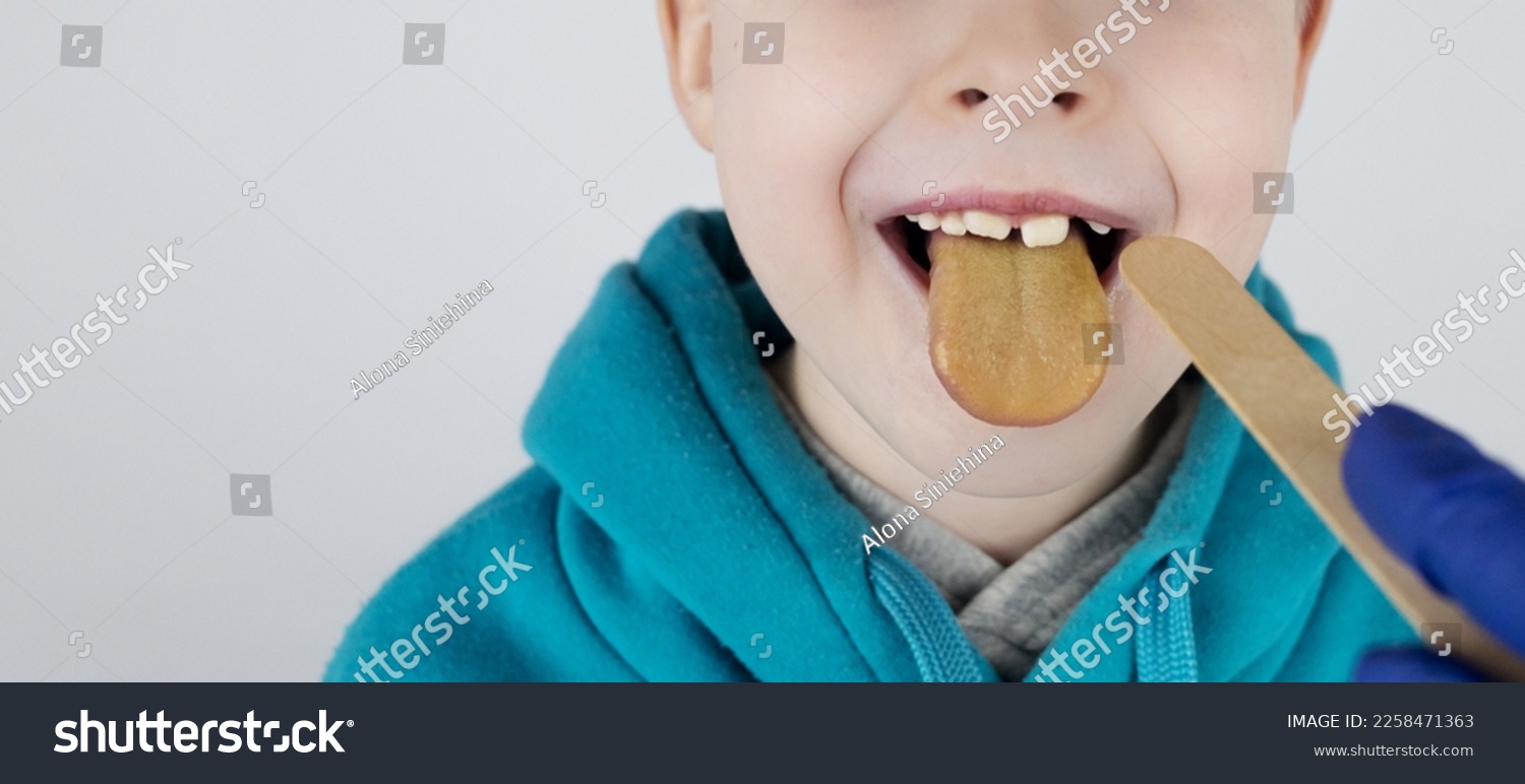 Blond boy has a yellow tongue. Painful yellow coating on the mucous membrane of the tongue. Diseases of the gastrointestinal tract, liver and gallbladder. The consequences of taking antibiotics. #2258471363