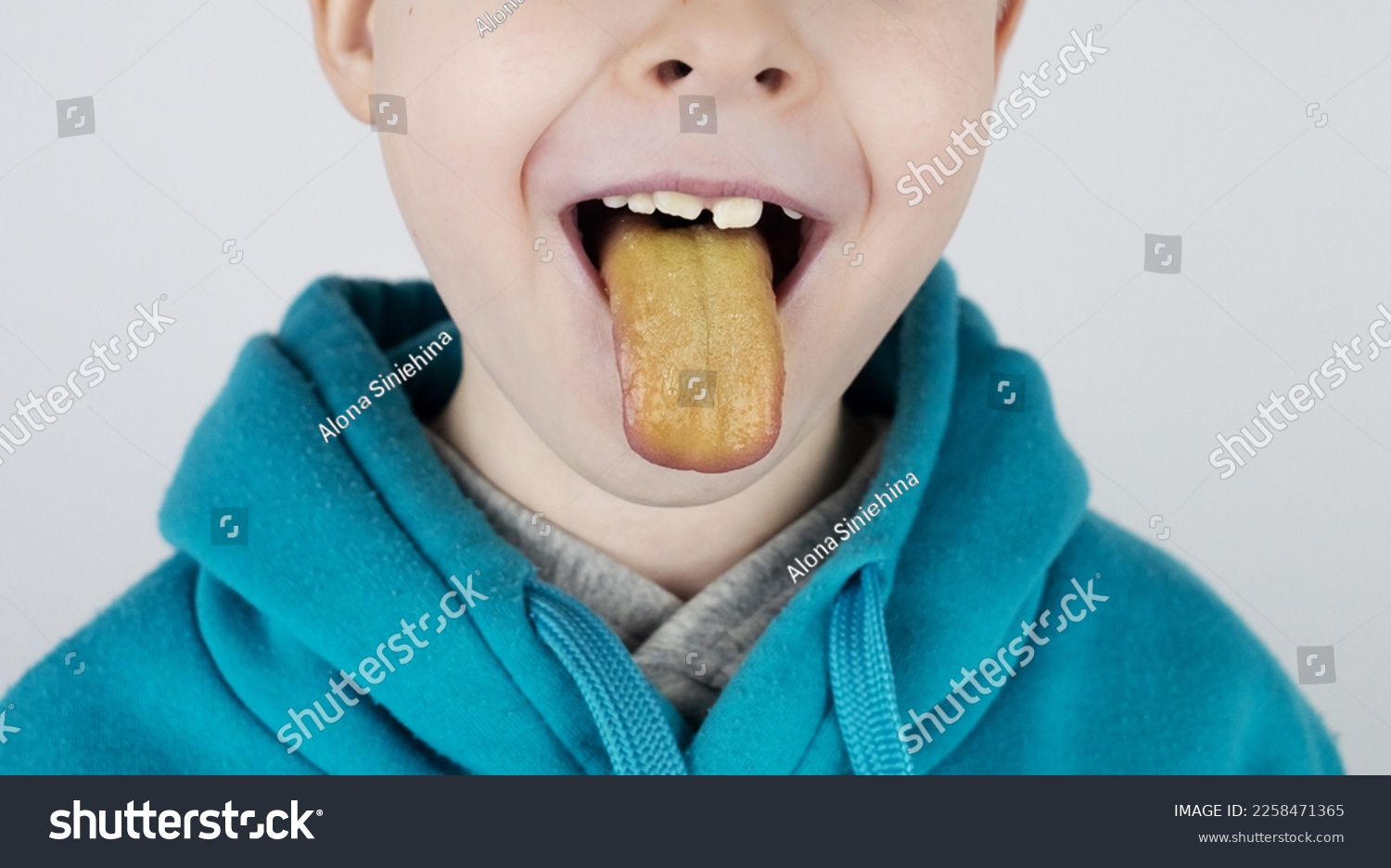 Blond boy has a yellow tongue. Painful yellow coating on the mucous membrane of the tongue. Diseases of the gastrointestinal tract, liver and gallbladder. The consequences of taking antibiotics. #2258471365