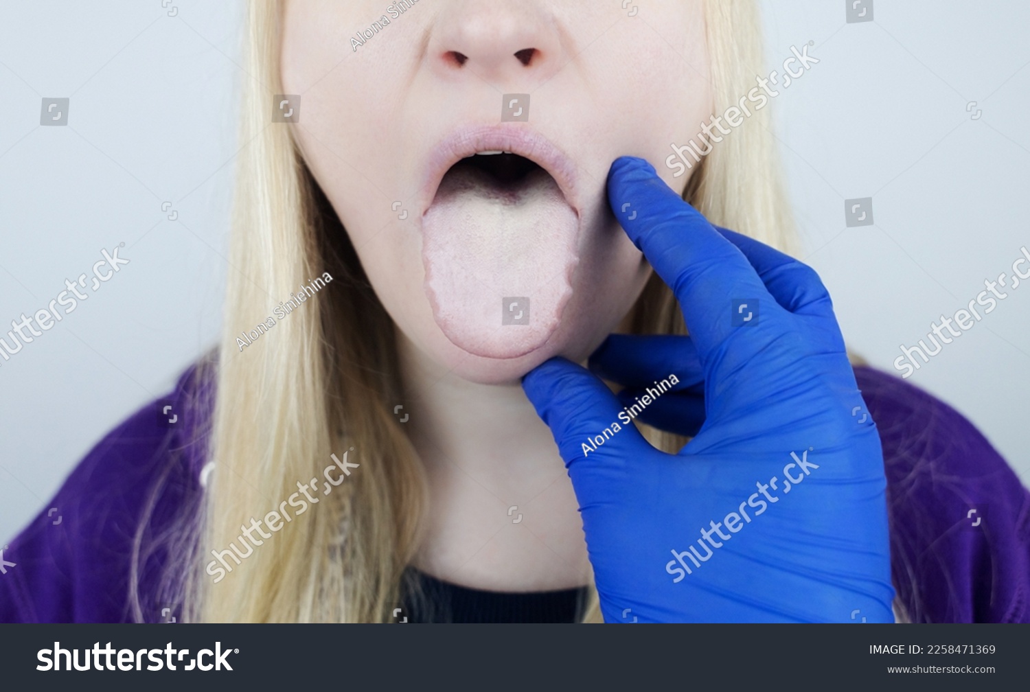 Woman has a white tongue. Painful white coating on the mucous membrane of the tongue. Diseases of the gastrointestinal tract, liver and gallbladder. The consequences of taking antibiotics. #2258471369