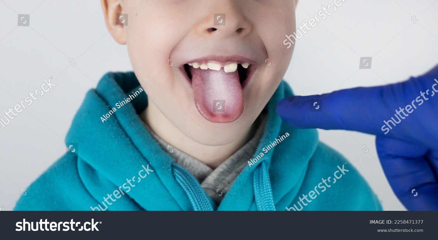 Blond boy has a white tongue. Painful white coating on the mucous membrane of the tongue. Diseases of the gastrointestinal tract, liver and gallbladder. The consequences of taking antibiotics. #2258471377