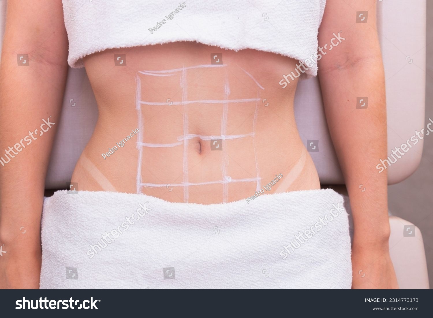 close-up photo of a woman's belly, photo of aesthetics, procedures on the abdomen. beauty clinic. ozone application, ozone therapy, enzymes, slimming. weight loss. #2314773173