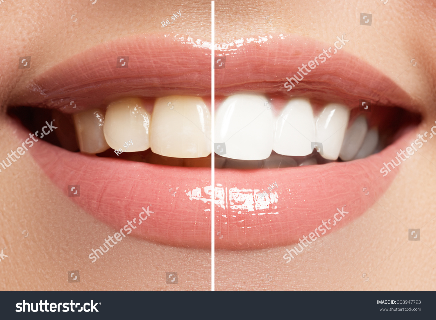 Perfect smile before and after bleaching. Dental care and whitening teeth #308947793