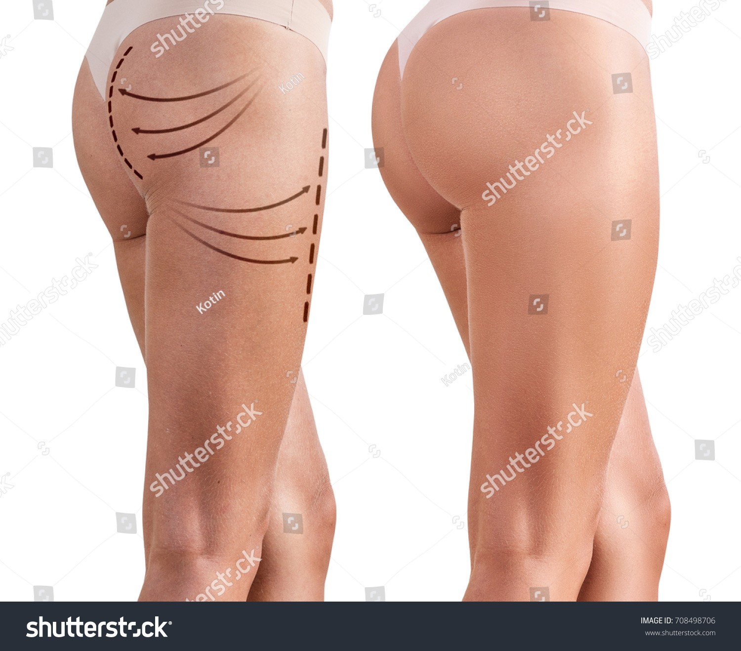 Woman's buttocks before and after plastic surgery #708498706