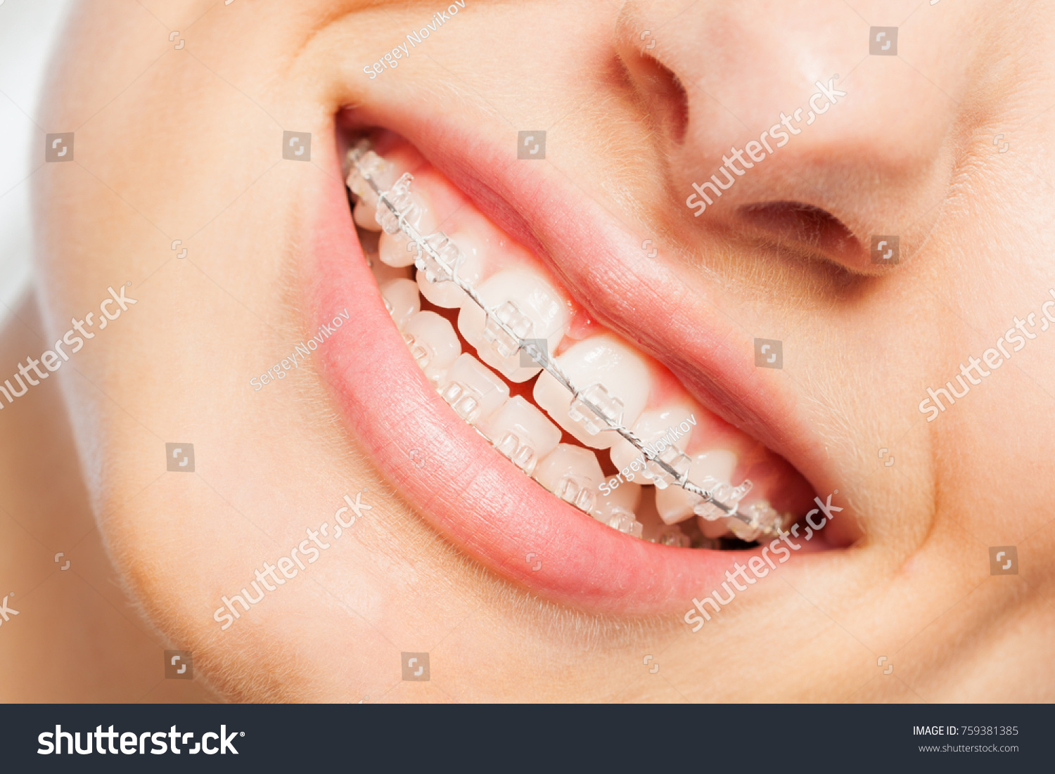 Happy smile of young woman with dental braces #759381385