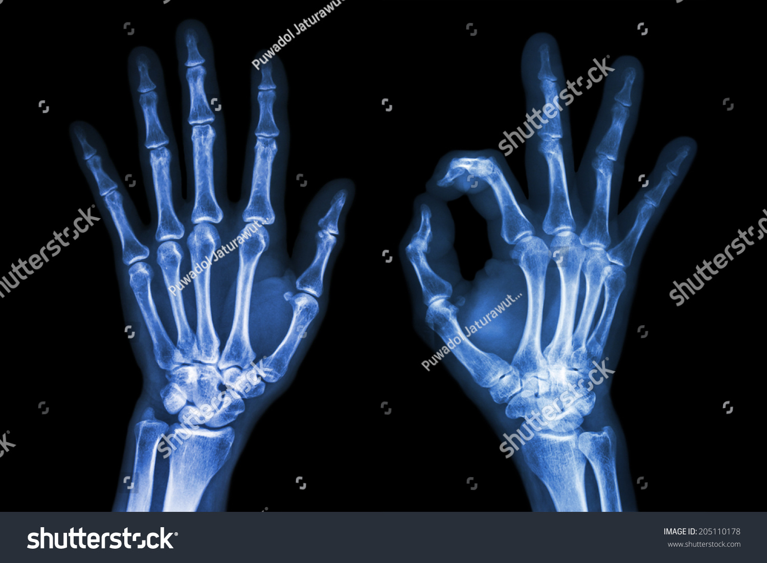 Edit Pictures Free Online - X-ray both | Shutterstock Editor