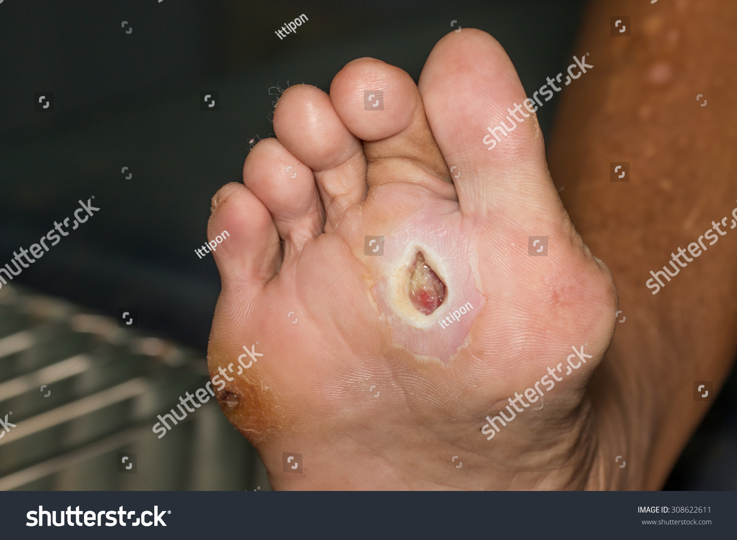 Edit Images Free Online - wound of diabetic | Shutterstock Editor