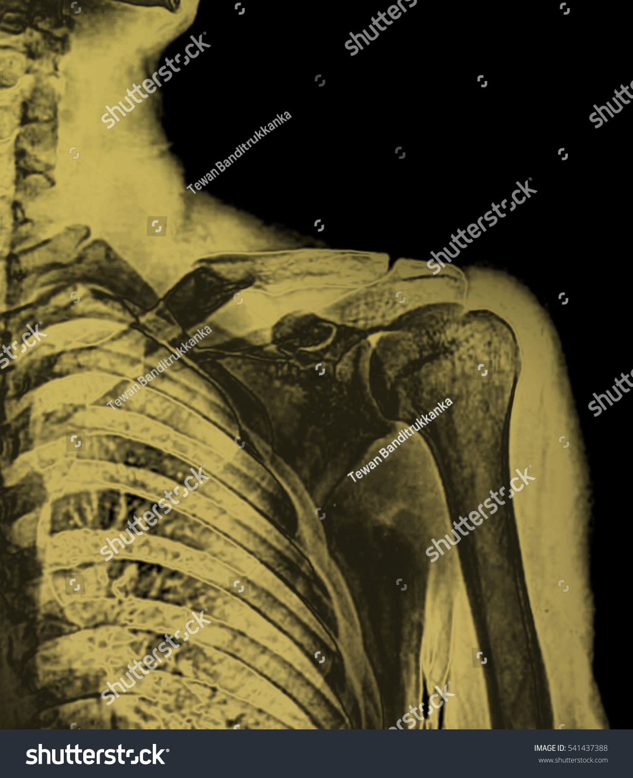 Edit Pictures Free Online - X-ray image | Shutterstock Editor