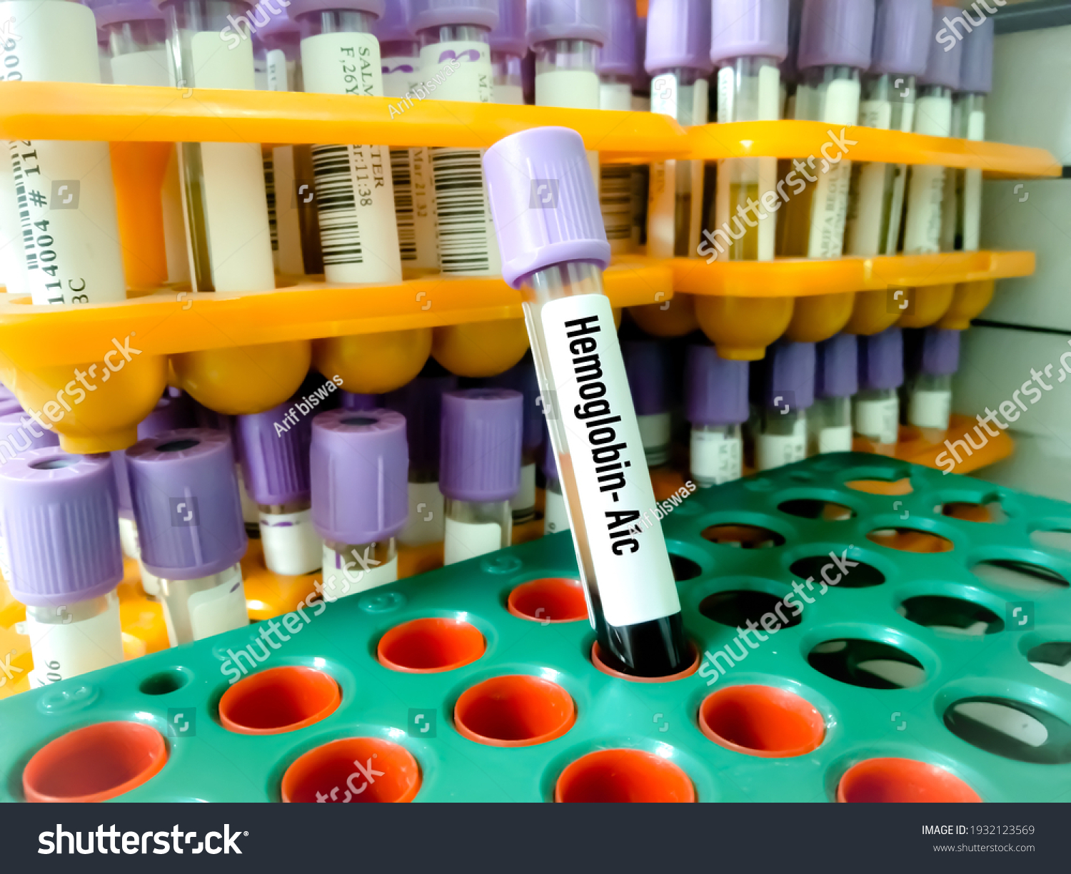 Blood Sample Hemoglobin A1c Hba1c Test Foto Stock 1932123569 Shutterstock