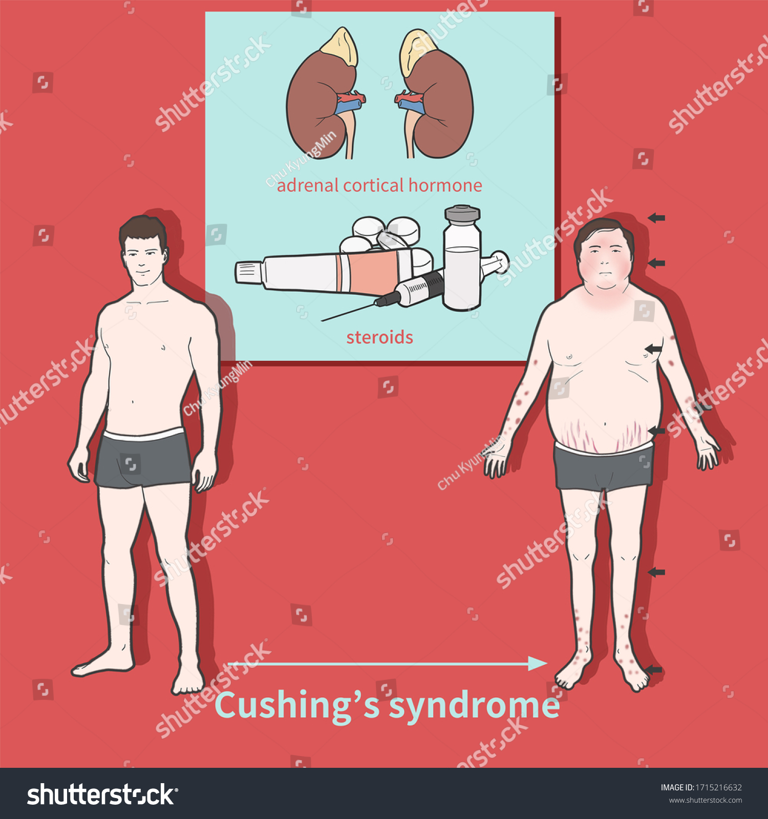 Ilustrasi Stok Cartoon Medical Illustration Explain Cushings Syndrome 1715216632 Shutterstock 